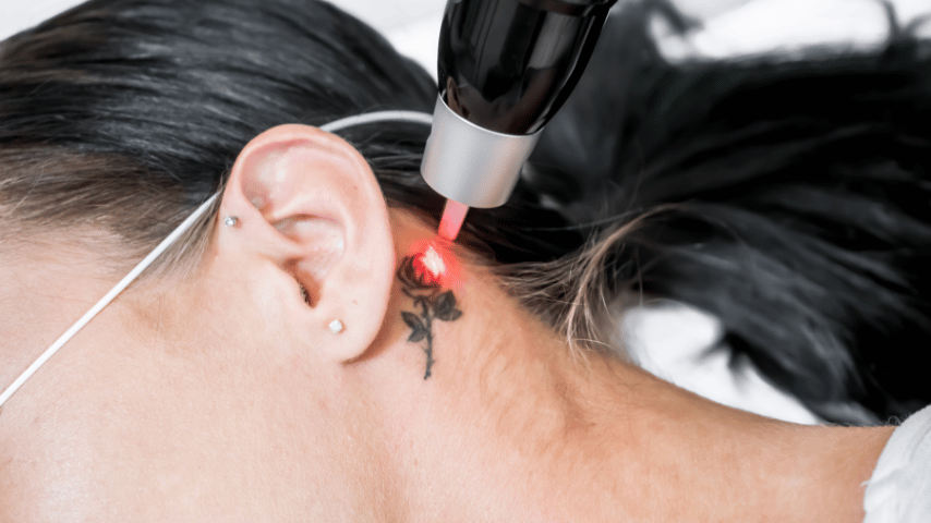 eliminación de tatuaje
